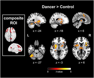 Embodied metacognition as strengthened functional connection between neural correlates of metacognition and dance in dancers: exploring creativity implications